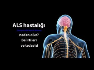 ALS Hastalığı Nedir? Belirtileri ve Süreci